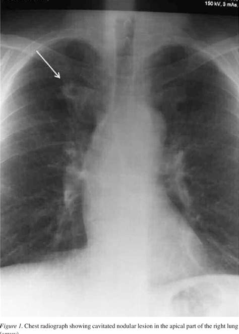 Rheumatoid lung nodulosis during anti